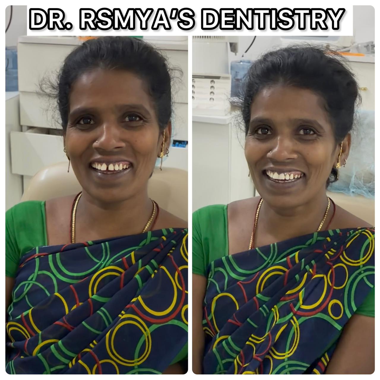 Composite Restoration Transformation