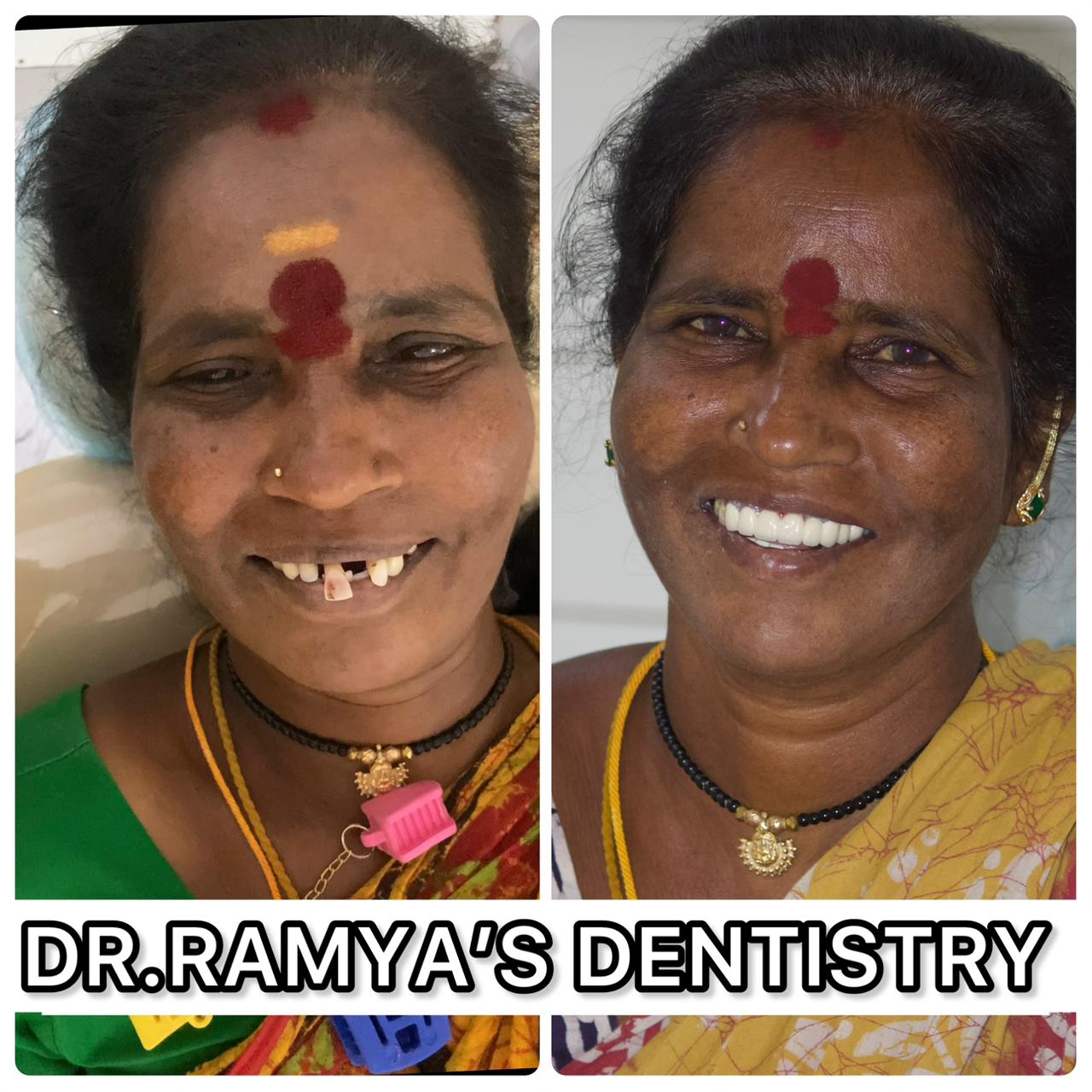 Smile Makeover Transformation