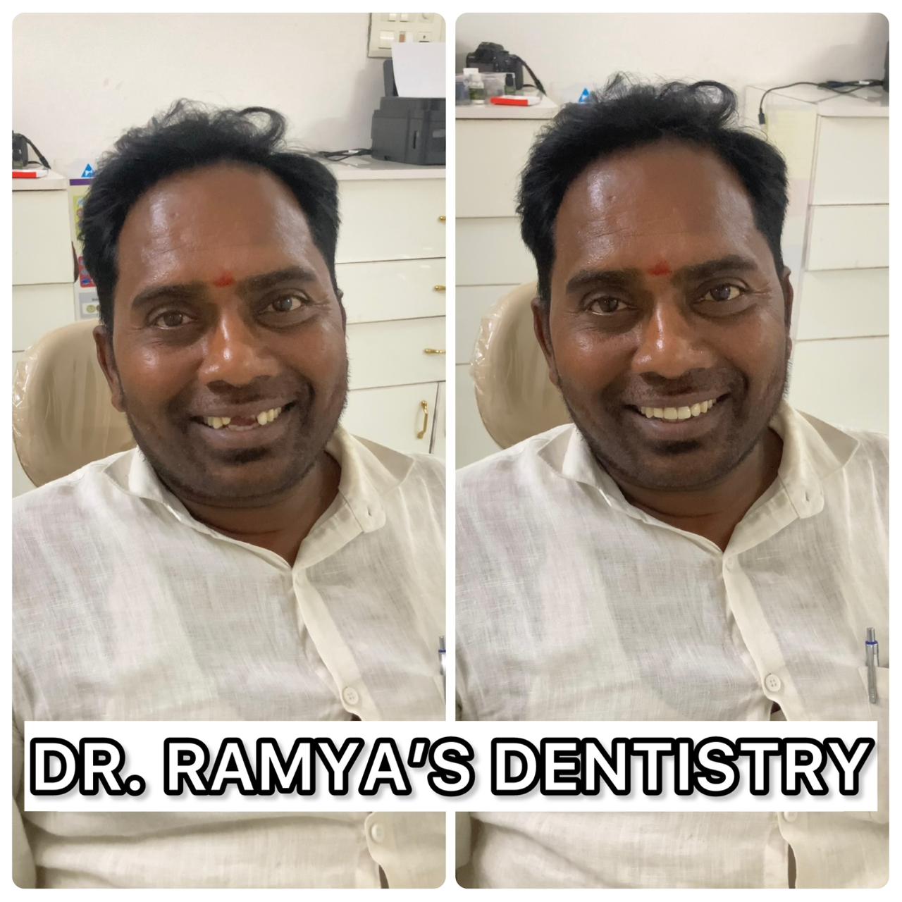 Teeth Replacement Transformation
